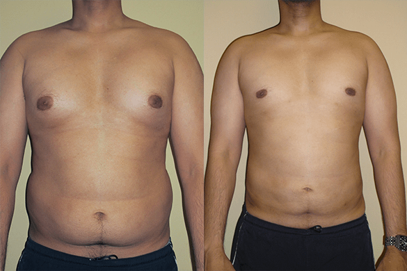 Abdomen, Flanks, and Back liposuction Before & Afte Photos Front