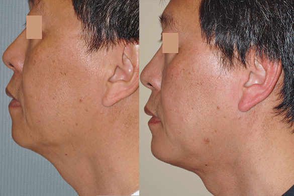 neck liposuction Before & Afte Photos Left