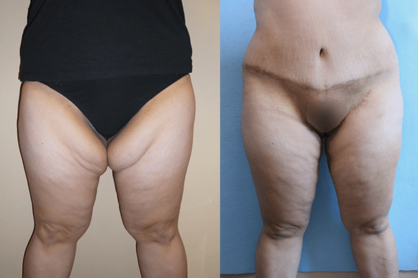 Thigh Lift Before & After Photos