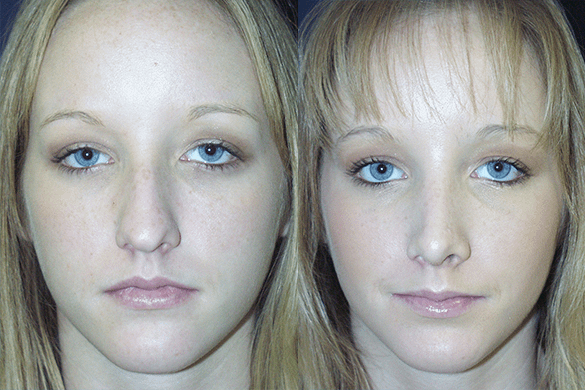 Rhinoplasty Before & After Photos Front