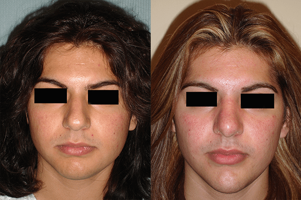 Rhinoplasty & Chin Augmentation Before & After Photos Front