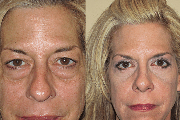 Rhinoplasty & Eyelid Surgery Before & After Photos Front