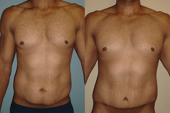Tummy Tuck Before & After pBefore & After Photos Front
