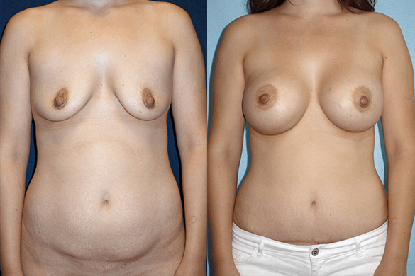 Mommy Makeover & Tummy Tuck Before & After Photos Front