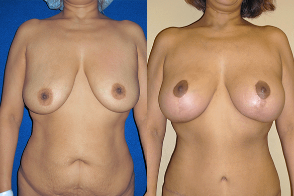 Mommy Makeover & Tummy Tuck Surgery Before & After Photos Front