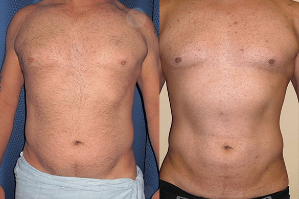 liposuction Before & After Photos