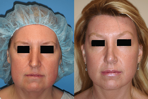 Face and Neck Lift Before & After Photos Front