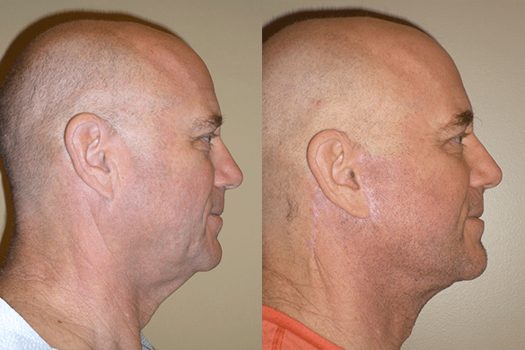 Face and Neck Lift Before & After Photos