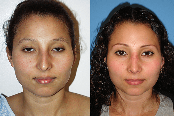 Rhinoplasty Before & After Photos Front