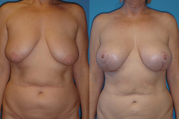 Breast Augmentation With Lift Before & After Photos Front