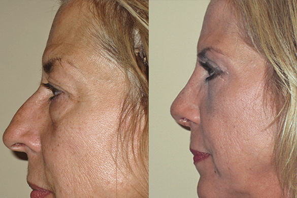 Eyelid Surgery Before & After Photos Left