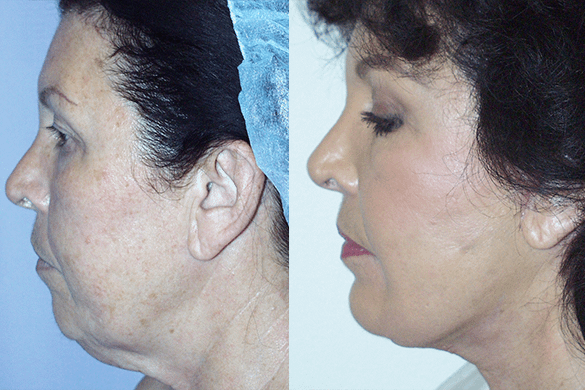 Face and Neck Lift Before & After Photos Left