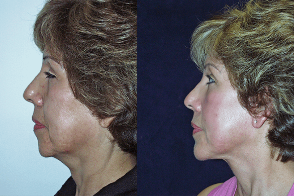 Face and Neck Lift with Chin Augmentation Before & After Photos Left