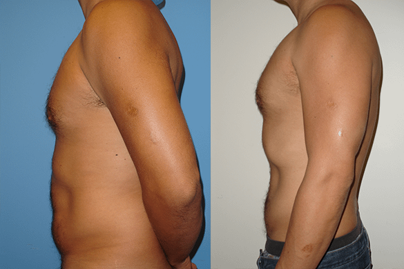 Abdomen Liposuction Before & After Photos Left