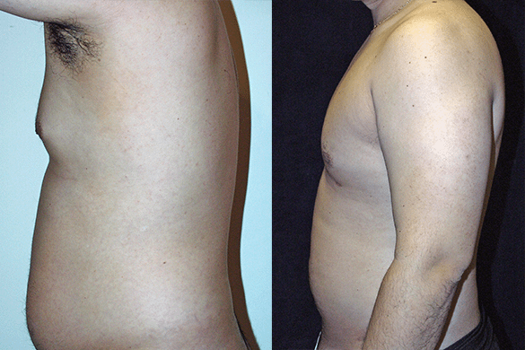 Abdomen, and Chest Liposuction Before & After Photos Left