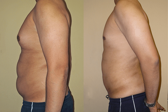 Abdomen, Flanks, and Back liposuction Before & Afte Photos Left