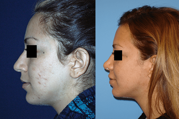 Rhinoplasty Before & After Photos Left