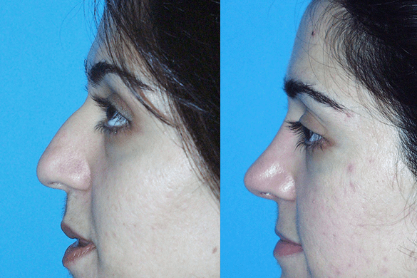 Rhinoplasty Before & After Photos Left