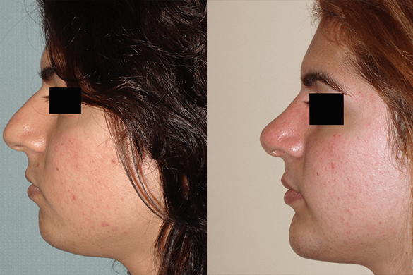 Rhinoplasty & Chin Augmentation Before & After Photos Left