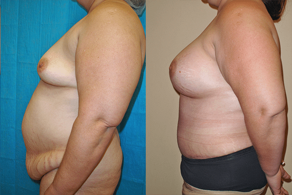 Mommy Makeover & Tummy Tuck Before & After Photos Left