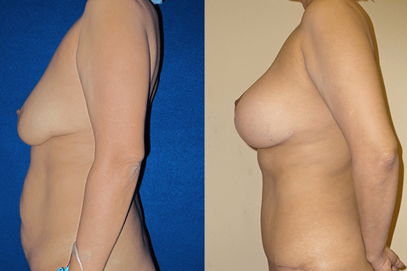 Mommy Makeover & Tummy Tuck Surgery Before & After Photos Left