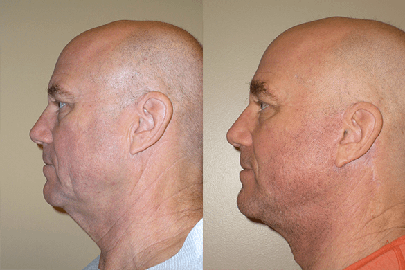 Face & Neck Lift for Men Before & After Photos