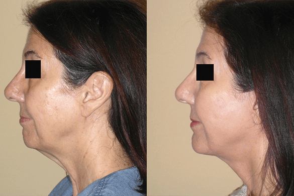 Face and Neck Lift Before & After Photos Left