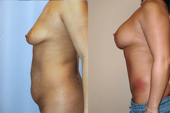 Breast Augmentation With Lift Before & After Photos Left