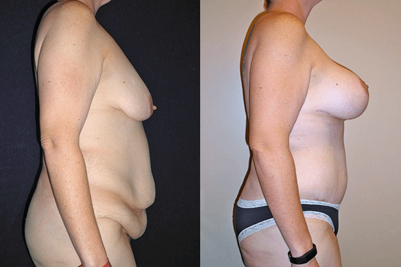 Breast Augmentation With Lift Before & After Photos Right