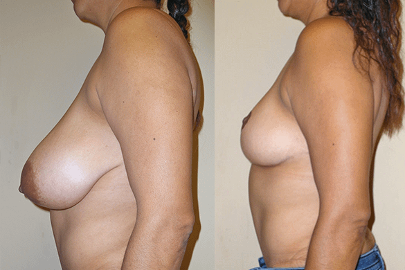 Breast Reduction Before & After Photos Left