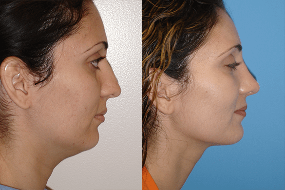 Rhinoplasty Before & After Photos Right