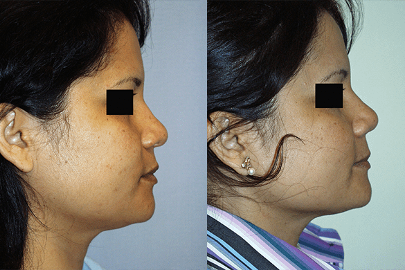 Rhinoplasty Before & After Photos Right