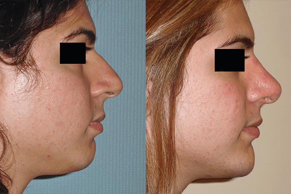 Rhinoplasty & Chin Augmentation Before & After Photos Right
