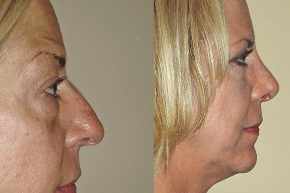 Rhinoplasty & Eyelid Surgery Before & After Photos Right