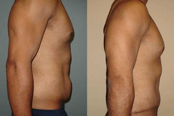 Tummy Tuck Before & After Photos Right
