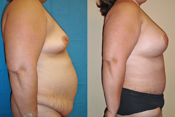 Mommy Makeover & Tummy Tuck Before & After Photos Right