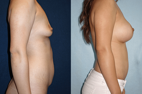 Mommy Makeover & Tummy Tuck Before & After Photos Right