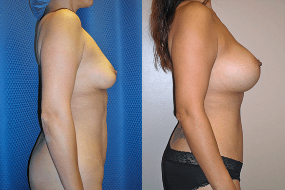 Mommy Makeover with Tummy Tuck Before & After Photos Right