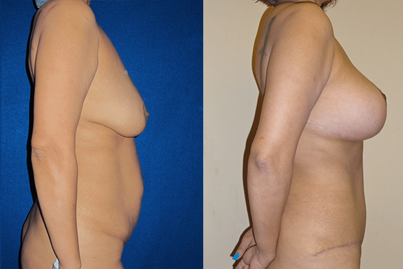 Mommy Makeover & Tummy Tuck Surgery Before & After Photos Right