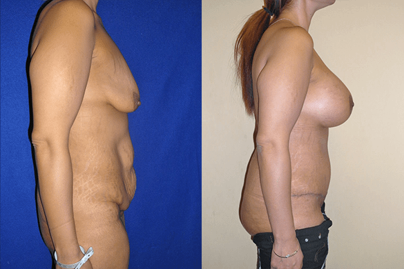 Mommy Makeover & Tummy Tuck Surgery Before & After Photos Right