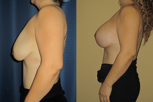 Breast Augmentation With Lift Before & After Photos