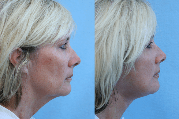 Face and Neck Lift plastic surgery Before & After Photos