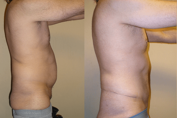 liposuction Before & After Photos
