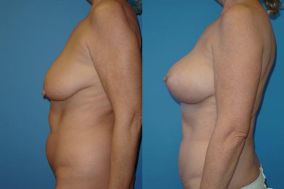 Breast Augmentation With Lift Before & After Photos Left