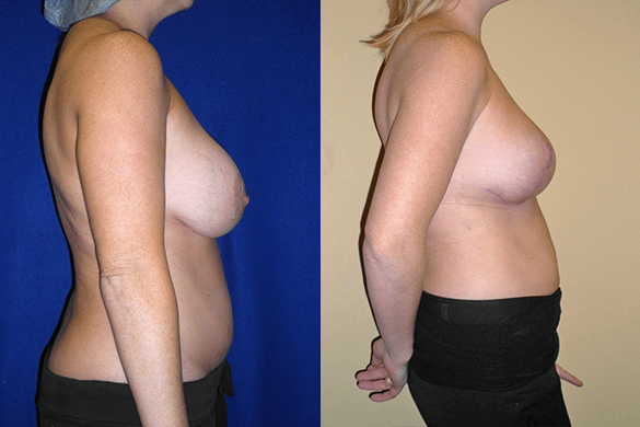 Breast Augmentation With Lift Before & After Photos