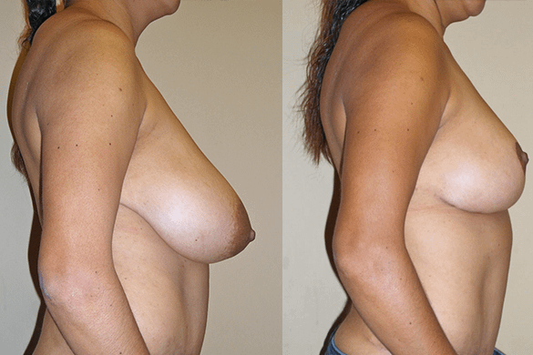 Breast Reduction Before & After Photos Right