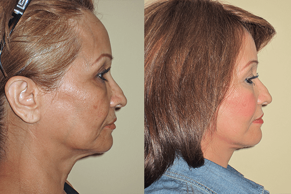 Face and Neck Lift Before & After Photos Right