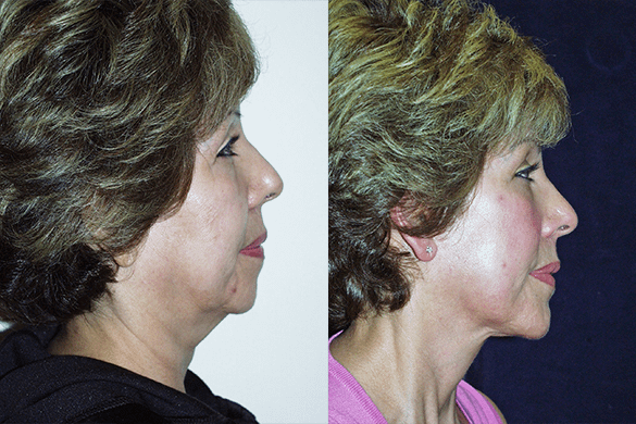 Face and Neck Lift with Chin Augmentation Before & After Photos Right