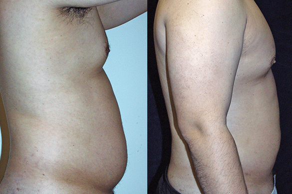 Abdomen, and Chest Liposuction Before & After Photos Right