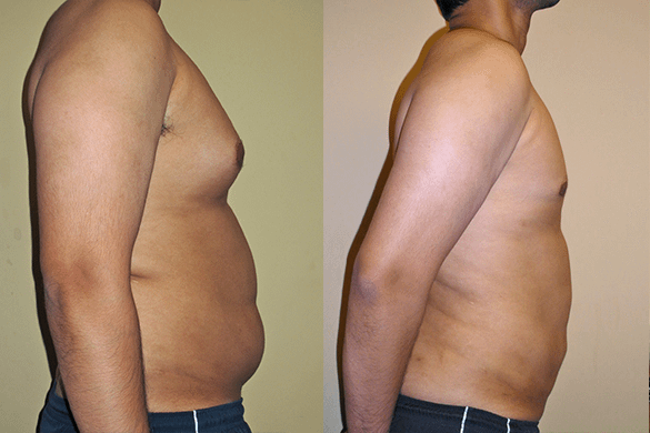 Abdomen, Flanks, and Back liposuction Before & Afte Photos Right